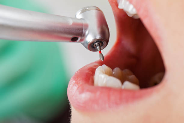Best Emergency Treatment for Dental Infections or Abscesses in Boyes Hot Springs, CA
